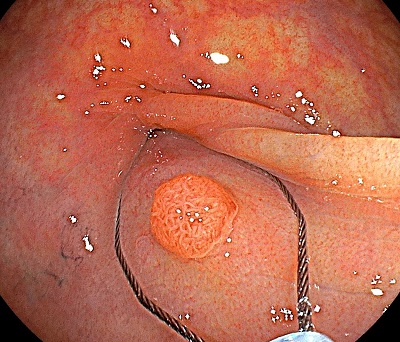 大腸ポリープを切除する意味とは？